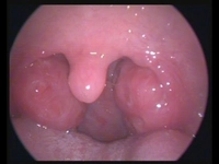Bademcik Ameliyatından Sonra Sigara