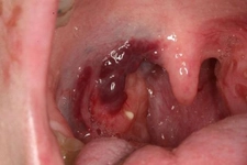 Bademcik Taşı Gargara Nasıl Yapılır?