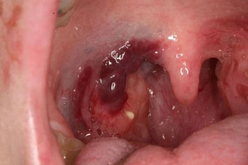 Bademcik İltihabı Temizleme Yöntemleri