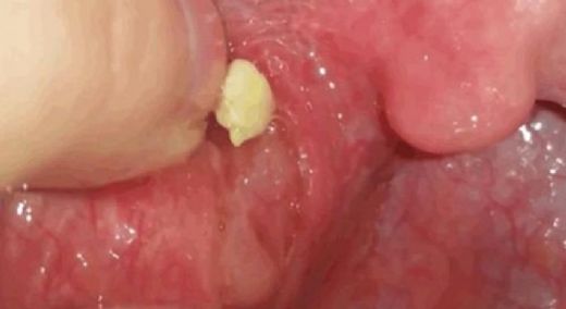 Ağız Kokusu Bademcik Tedavisi