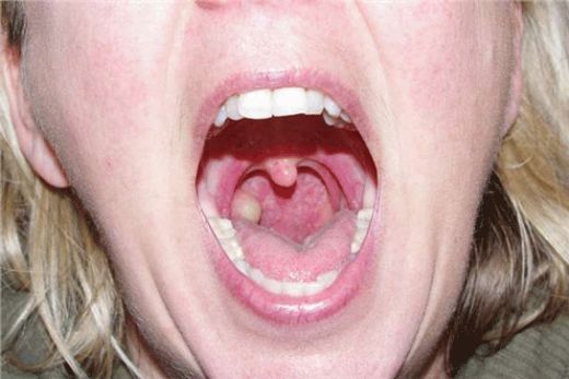 Bademcik Ağrısı Ne İyi Gelir?