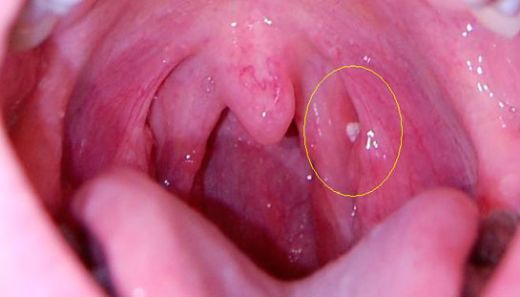 Bademcik Ağrısına Ne İyi Gelir?