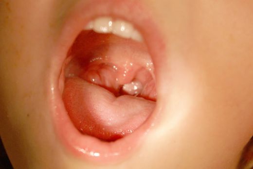 Bademcik Ameliyatı Sonrası Ateş