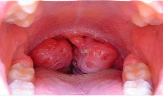 Bademcik Ameliyatı Sonrası Bakım