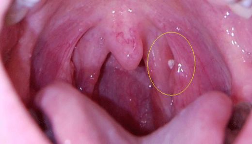 Bademcik Ameliyatı Sonrası Dilde Beyazlık