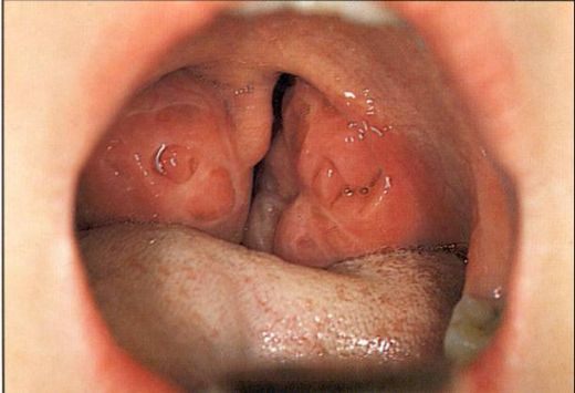 Bademcik Ameliyatı Sonrası Ses Kısıklığı