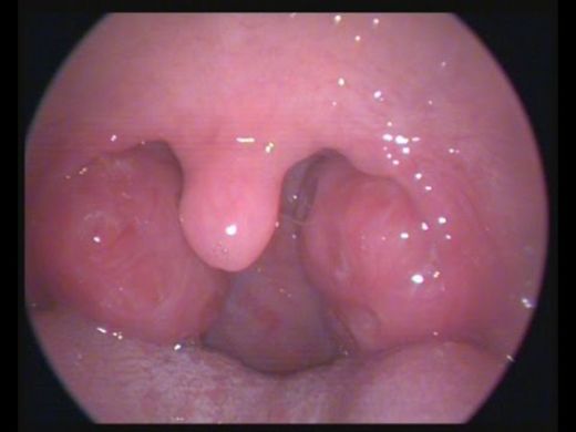 Bademcik Ameliyatından Sonra