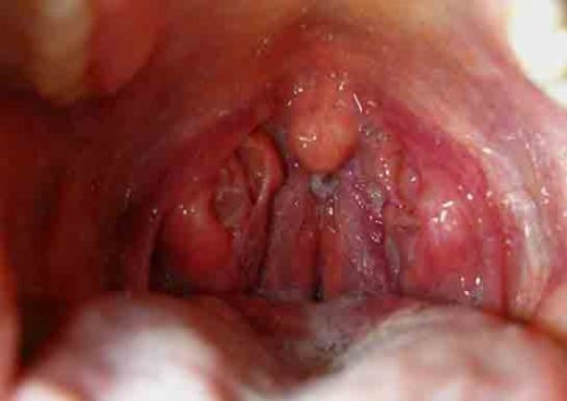 Bademcik Ameliyatından Sonra İyileşme Süresi
