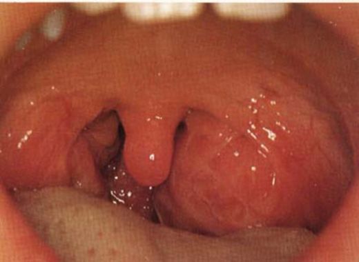 Bademcik Büyümesi Belirtileri ve Tedavisi