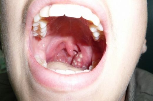 Bademcik Enfeksiyonu Belirtileri ve Tedavisi