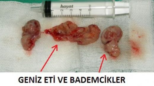 Bademcik Geniz Eti Ameliyatı Sonrası