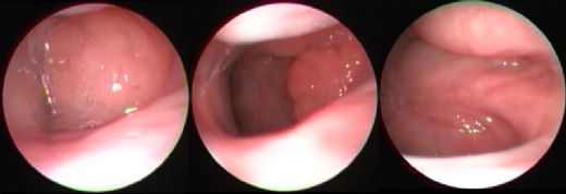 Bademcik Geniz Eti Ameliyatı Sonrası Beslenme