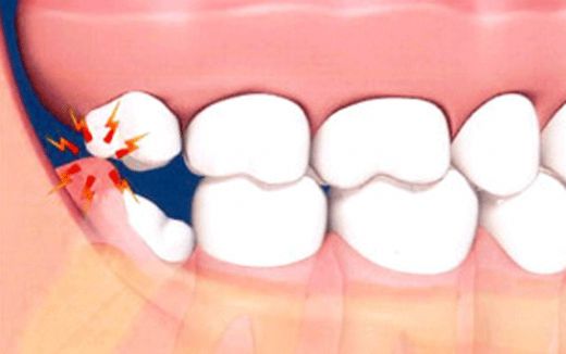 Bademcik İltihabı Diş Ağrısı Yapar mı?