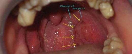 Bademcik İltihabı Patlatma Nedir?