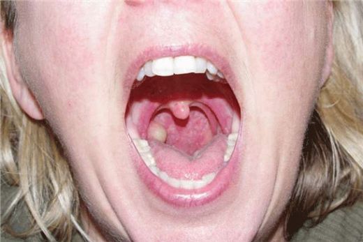 Bademcik Küçültme Ameliyatı Riskleri ve Sonrası