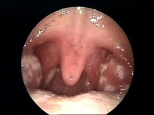 Bademcik Taşı Çözümü Nelerdir?