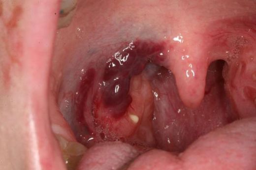 Bademcik Taşı Gargara Nasıl Yapılır?