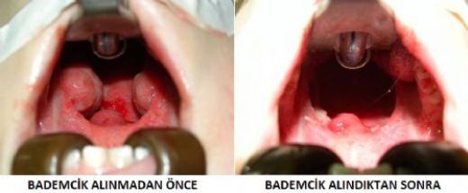 Bademcik ve Geniz Eti Ameliyatı Riskleri ve Sonrası