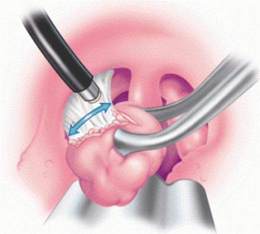 Bademcikleri Aldırmak Zararlı mıdır?