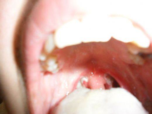 Bebeklerde Bademcik Ameliyatı Sonrası