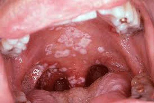 Boğaz Bademcik İltihabı Belirtileri ve Tedavisi