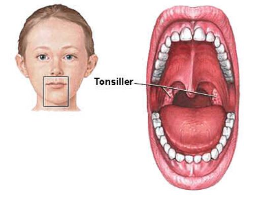 Çocuklarda Bademcik Ameliyatı Sonrası