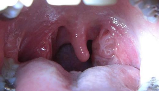Sol Bademcik Şişmesi Belirtileri ve Tedavisi