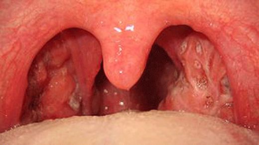 Tek Bademcik Şişmesi Belirtileri ve Tedavisi