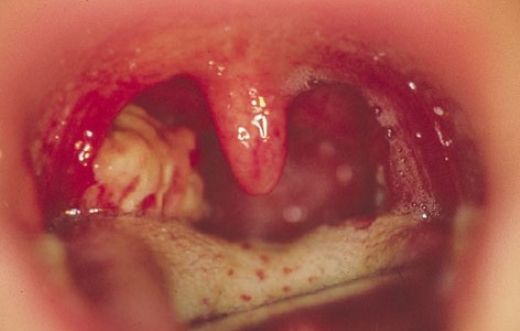 Zehirli Bademcik Belirtileri ve Tedavisi